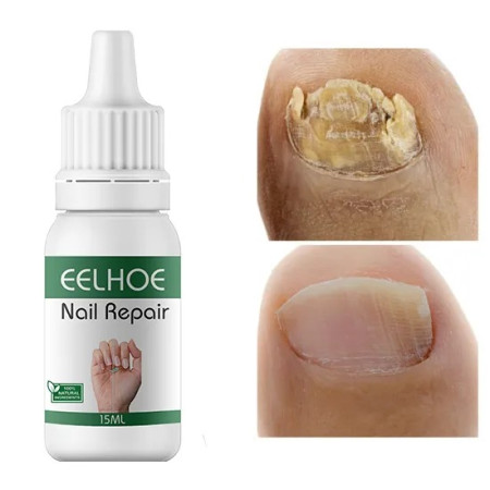 2 Pis Original EELHOE Nail Repair Serum (15 ML)